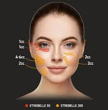 Etrebelle PLA+HA – Hybrydowy wypełniacz estetyczny (PLA + HA 200 mg) - obrazek 3